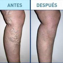 Clínica de Varices en Madrid Centro Vascular
