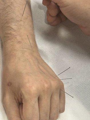 Acupuntura en Madrid | Genki
