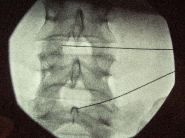 OZONOTERAPIA INSTITUTO MADRILEÑO